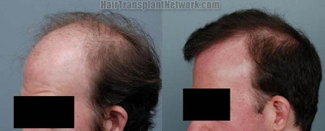 Left view before and after hair transplant