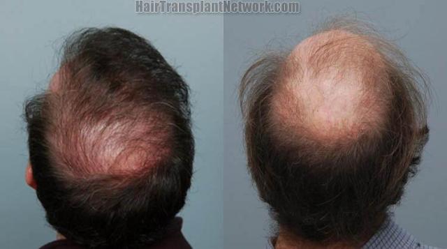 Hair restoration before and after images