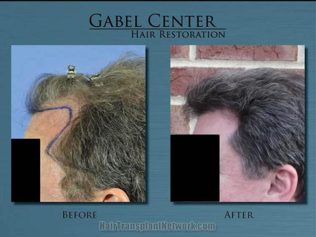 Left view images before and after hair transplantation