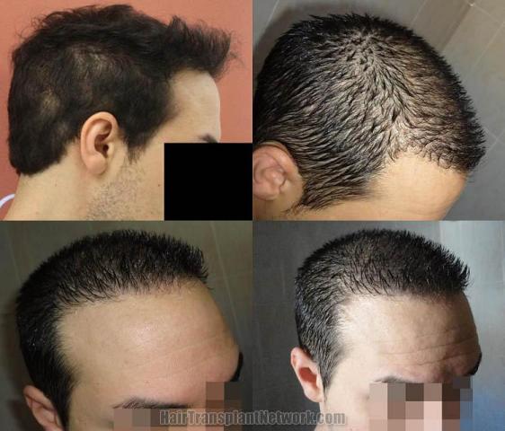 Hair transplantation surgery before and after photos