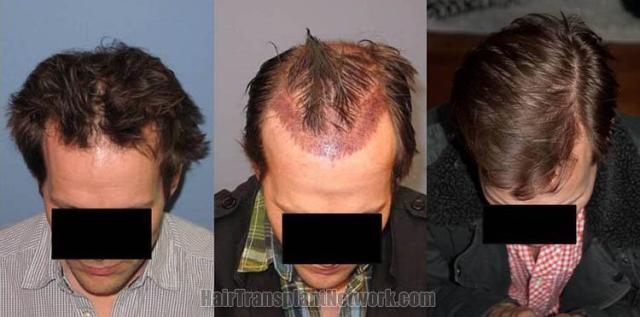 Tilt down view before and after hair transplant photos