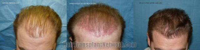 Top view before and after hair restoration results