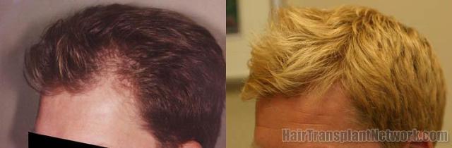 Hair restoration procedure results