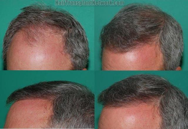 Photos showing before and after hair transplant results