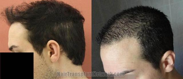 Hair transplantation surgery before and after images