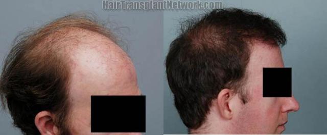 Hair transplant before and after pictures