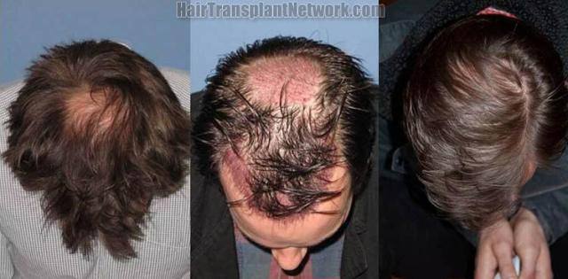 Top view before and after hair restoration procedure images