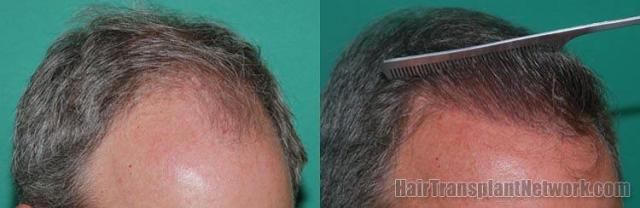 Right view before and after hair replacement procedure
