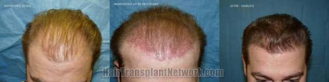 Tilt down view before and after hair transplant results