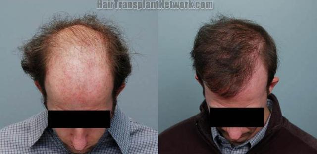 Top view before and after hair restoration procedure