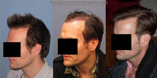 Left view before and after hair transplantation procedure 
