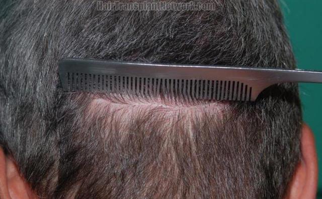 Photos showing residual scar from hair transplant donor