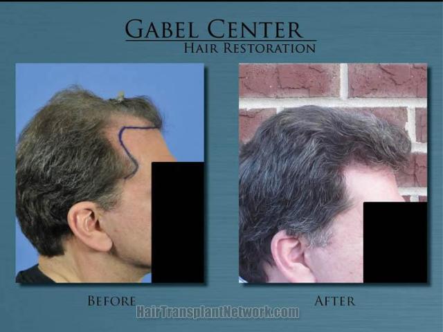 Right view photographs before and after hair restoration