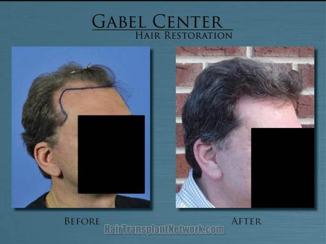Right oblique view before and after hair restoration 
