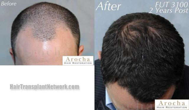 Hair transplantation surgery before and after photos