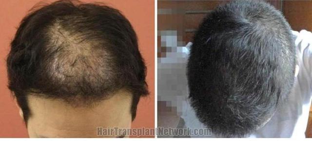 Hair restoration procedure before and after results