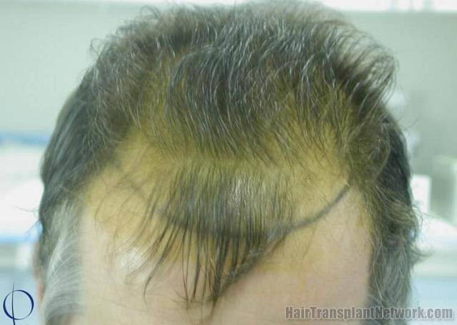 Hair transplantation surgery before and after photos