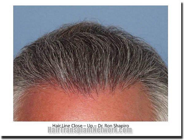 Hair restoration procedure results