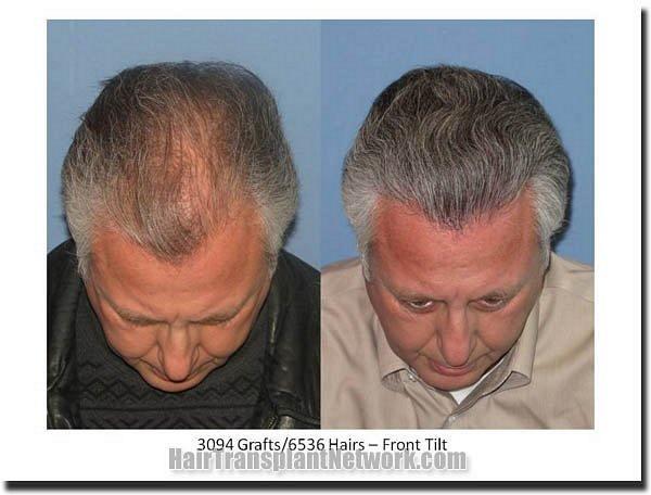 Hair restoration procedure results