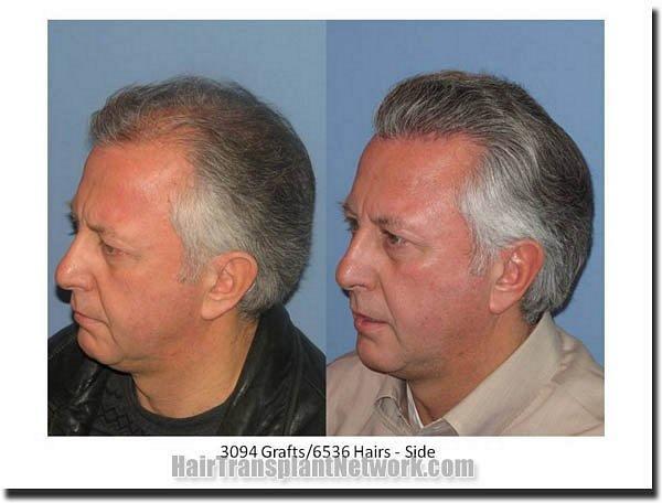 Hair restoration procedure results