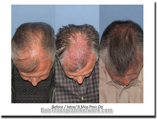 Hair restoration procedure results