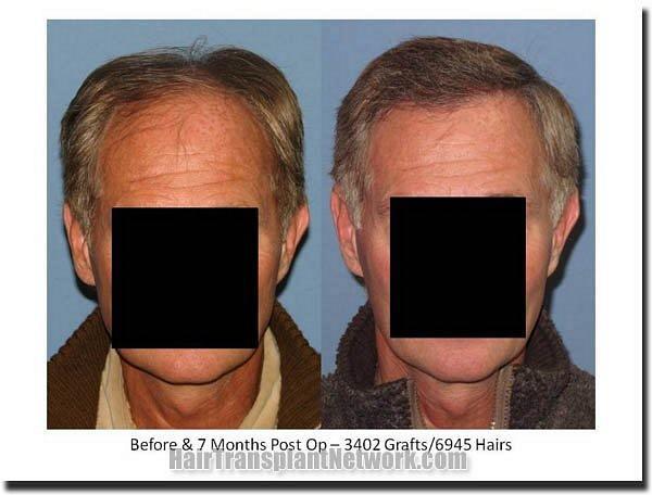 Hair restoration procedure results