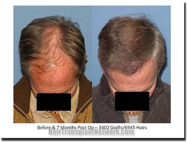 Hair restoration procedure results