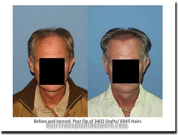 Hair restoration procedure results