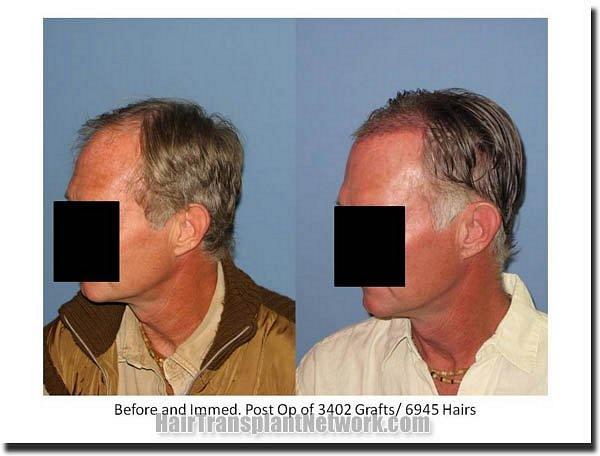 Hair restoration procedure results