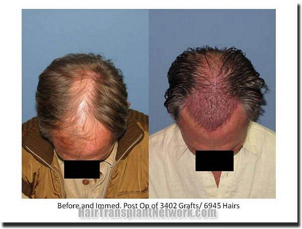 Hair restoration procedure results