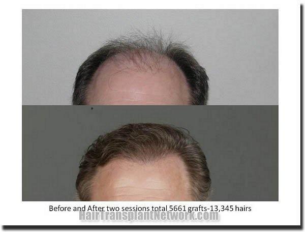 Hair restoration procedure results