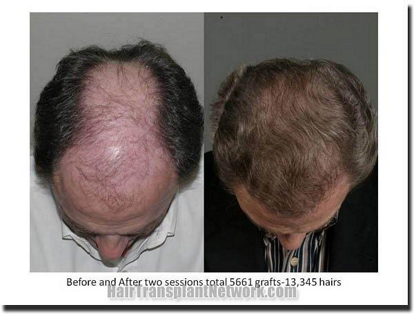 Hair restoration procedure results