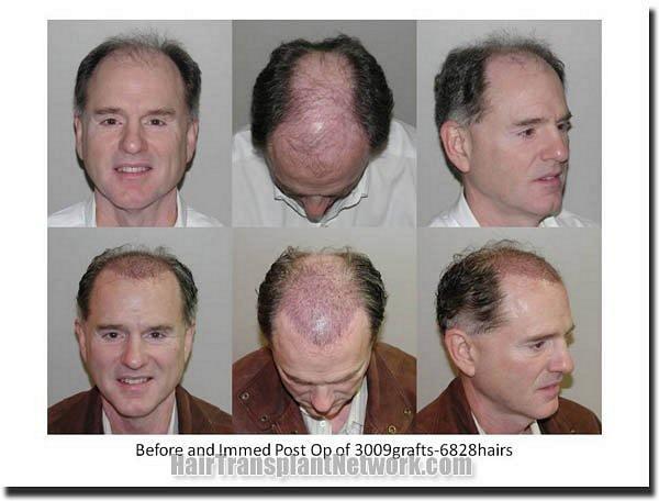 Hair restoration procedure results