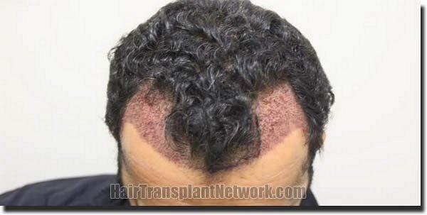 Hair restoration procedure results