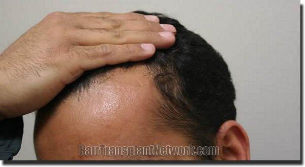 Hair restoration procedure results