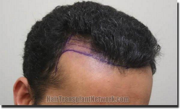 Hair restoration procedure results