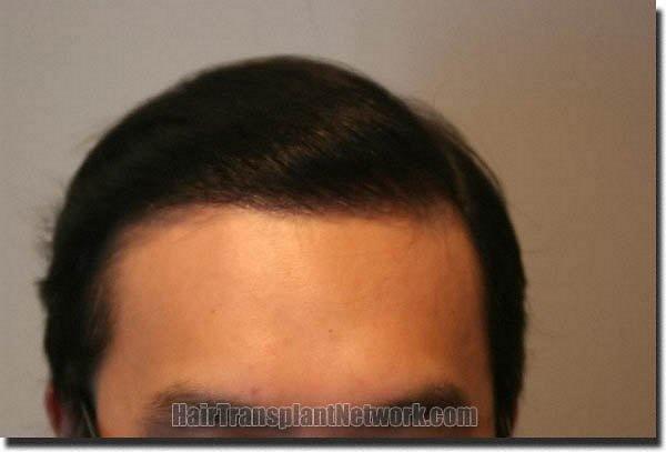 Hair restoration procedure results