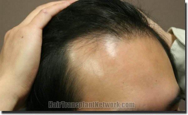 Hair restoration procedure results