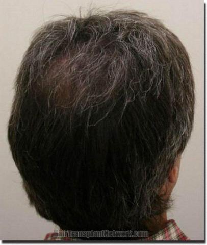 Hair restoration procedure results