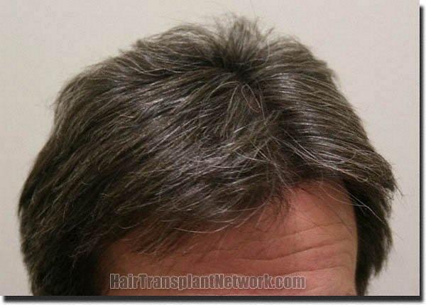 Hair restoration procedure results