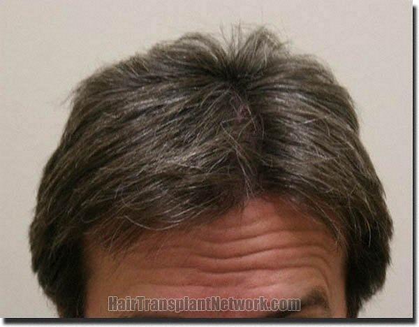 Hair restoration procedure results