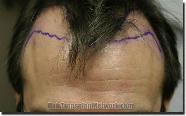 Hair restoration procedure results