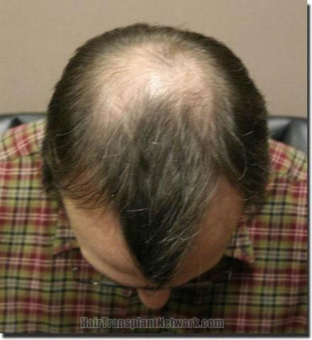 Hair restoration procedure results