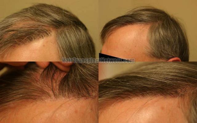 Hair restoration procedure before and after results