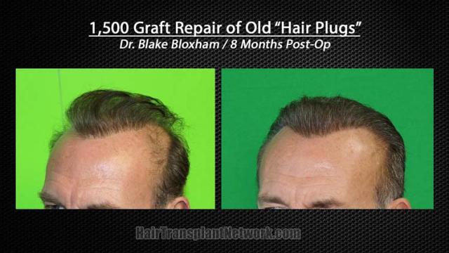Hair transplantation repair surgery before and after photos