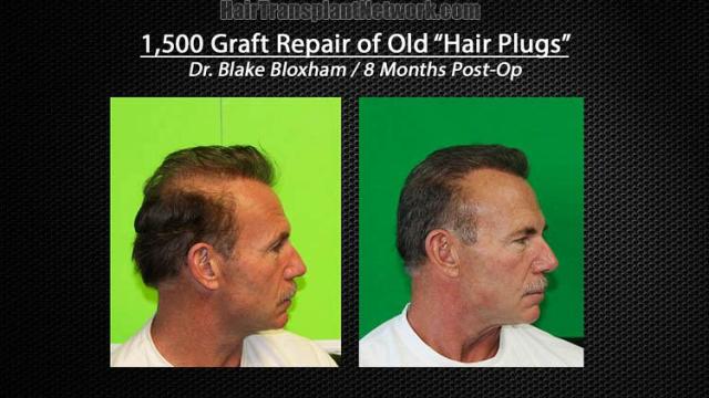 Hair restoration repair surgery before and after photos