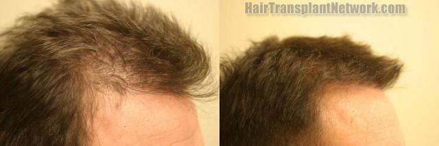 Hair transplantation surgery before and after images