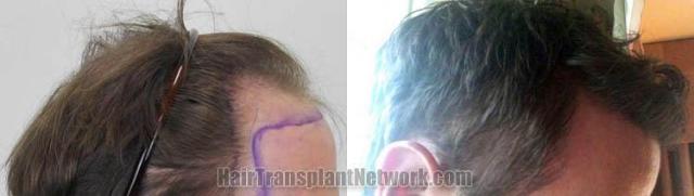 Hair transplantation surgery before and after pictures