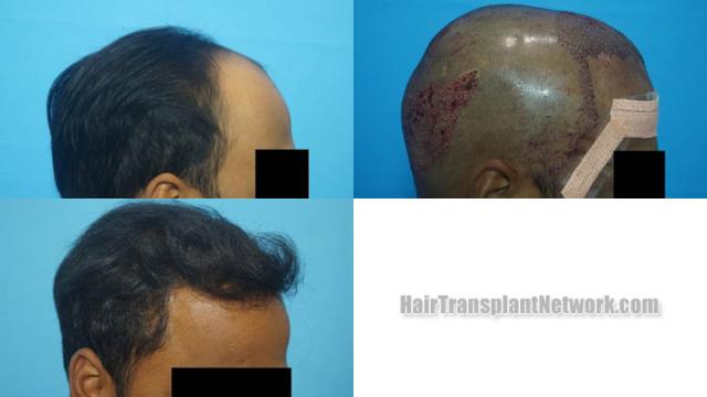 Hair transplantation procedure before and after results