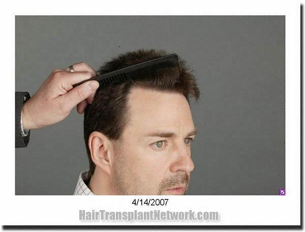 Hair restoration procedure results